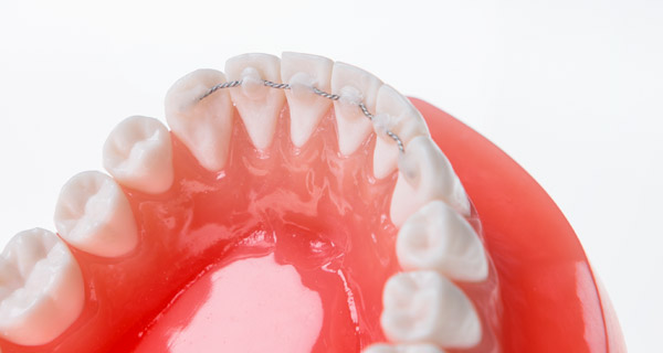 retainer